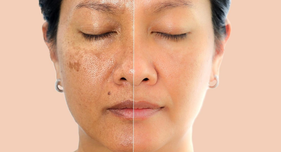 Hyperpigmentation