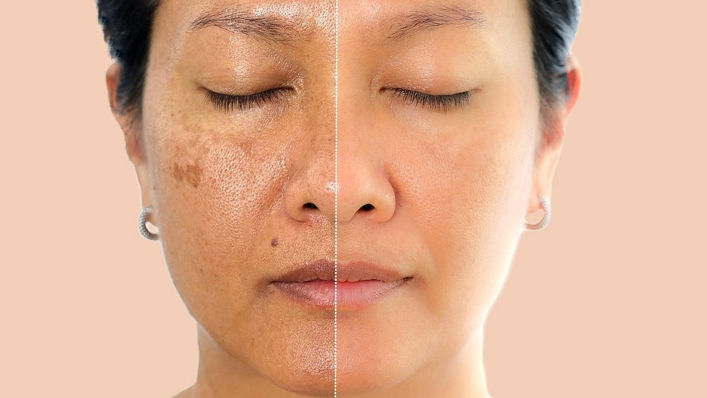 Hyperpigmentation