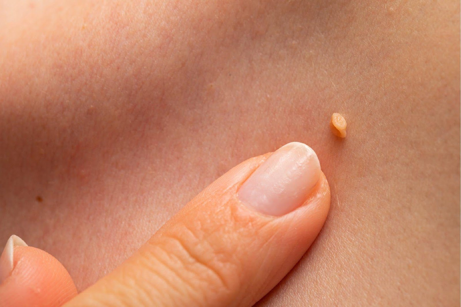 Warts on Skin