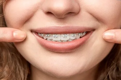 Exploring the 4 Non-Invasive Alternatives to Braces